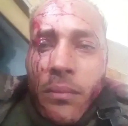 Pérez‘ Live-Instagram-Videos vom 15. Januar zeigen seine Verletzungen und Kapitulationsversuche